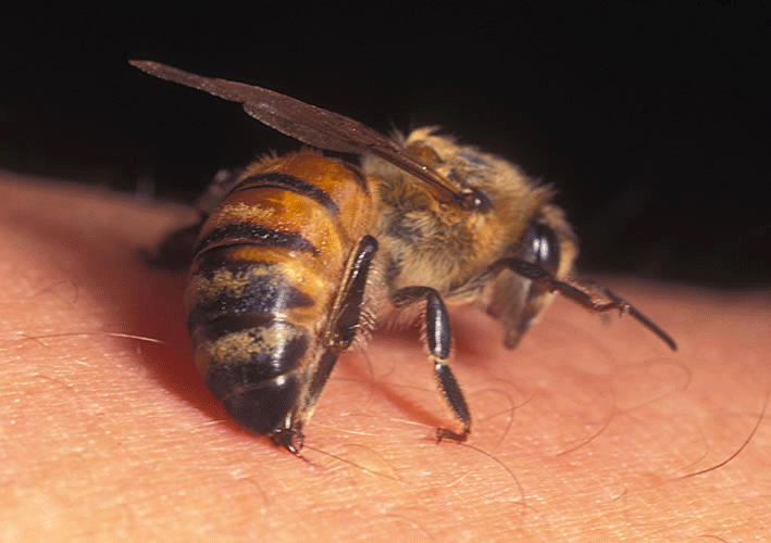 bumble bee sting